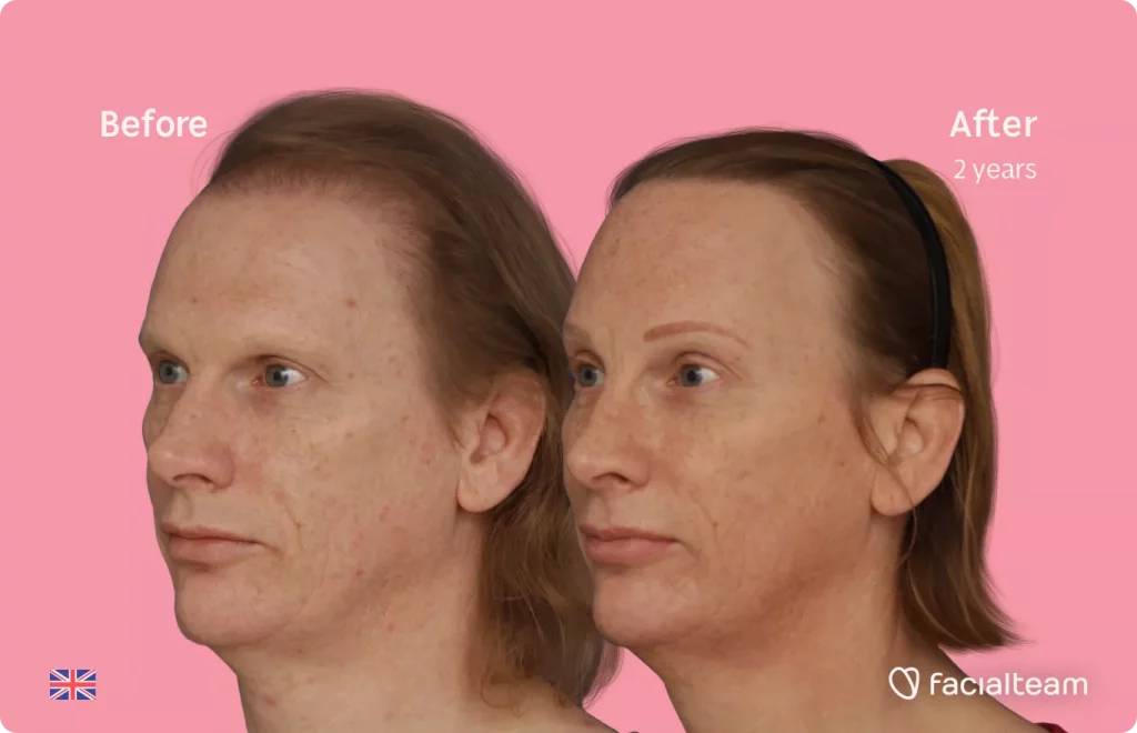 45 degree image of left side of FFS patient Joanne showing the results before and after facial feminization surgery consisting of forehead with SHT, rhinoplasty feminization surgery.