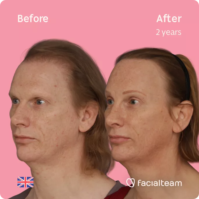 Square left side 45 degree image of FFS patient Joanne showing the results before and after facial feminization surgery consisting of forehead with SHT, rhinoplasty feminization surgery.