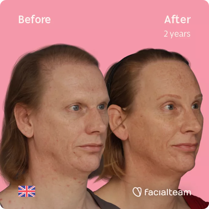 Square 45 degree image of FFS patient Joanne showing the results before and after facial feminization surgery consisting of forehead with SHT, rhinoplasty feminization surgery.