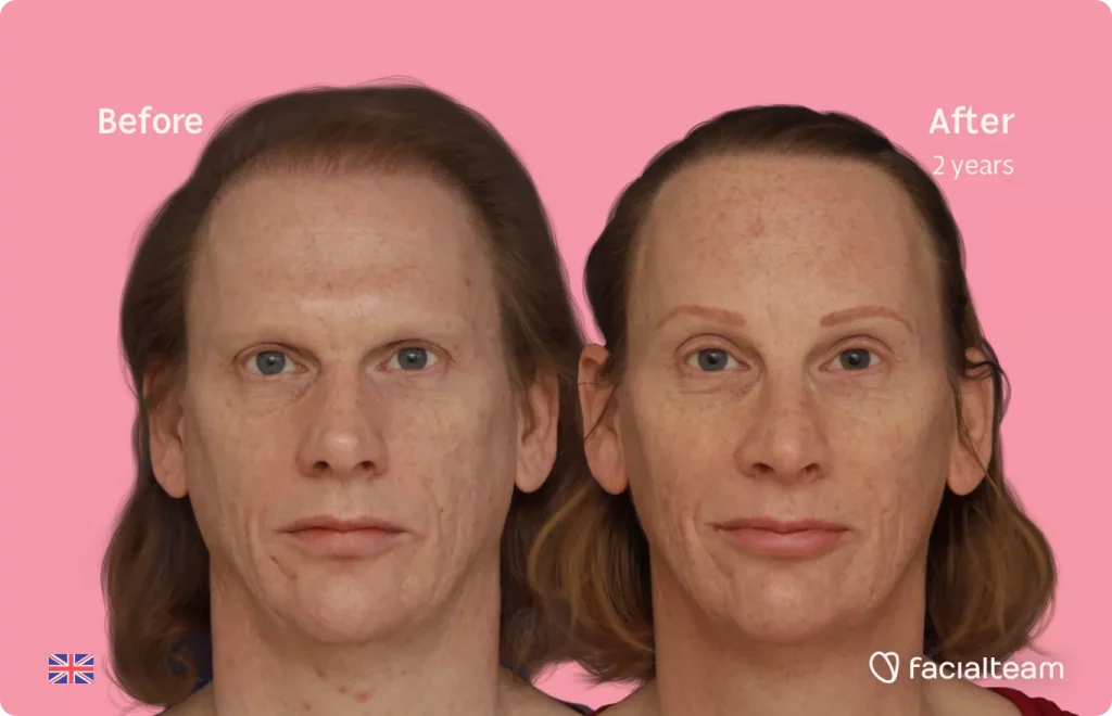 Frontal image of FFS patient Joanne showing the results before and after facial feminization surgery with Facialteam consisting of forehead with SHT, rhinoplasty feminization surgery.