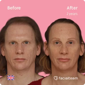 FFS patient Joanne from the UK before and after FFS Surgery with Facialteam, she underwent Forehead surgery and a feminizing rhinoplasty
