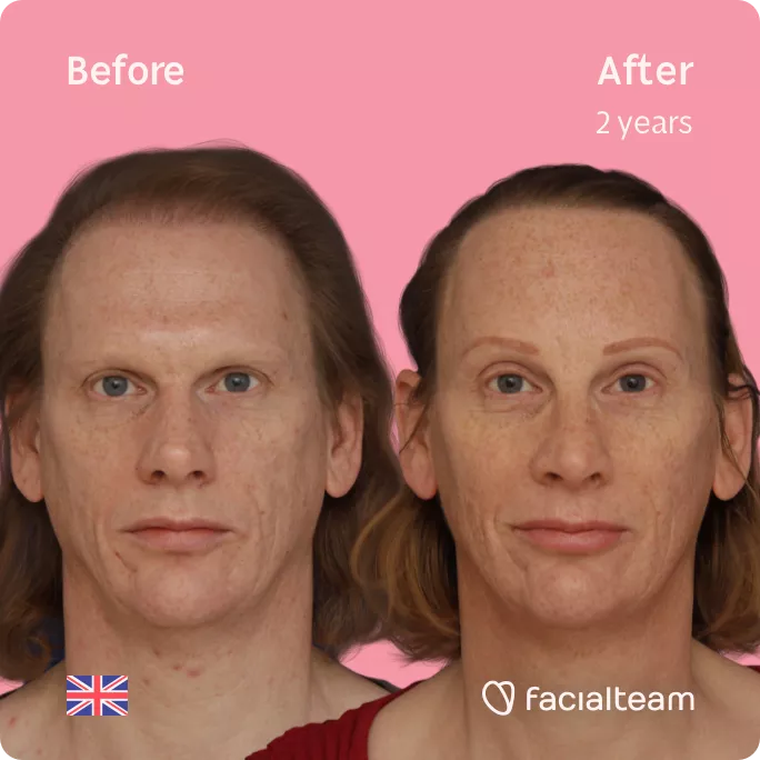 Square frontal image of FFS patient Joanne showing the results before and after facial feminization surgery with Facialteam consisting of forehead with SHT, rhinoplasty feminization surgery.
