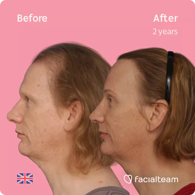 Left square Side image of FFS patient Joanne showing the results before and after facial feminization surgery with Facialteam consisting of forehead with SHT, rhinoplasty feminization surgery.