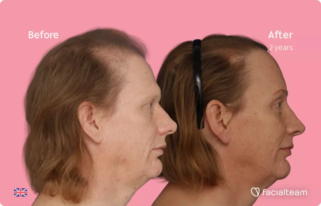 Side image of FFS patient Joanne showing the results before and after facial feminization surgery with Facialteam consisting of forehead with SHT, rhinoplasty feminization surgery.