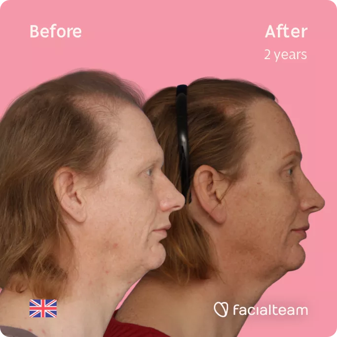Square Side image of FFS patient Joanne showing the results before and after facial feminization surgery with Facialteam consisting of forehead with SHT, rhinoplasty feminization surgery.
