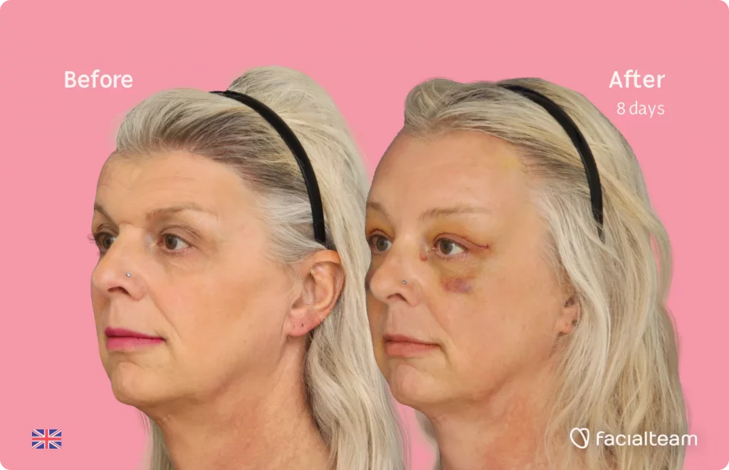 45 degree image of FFS patient Skye showing the results before and after facial feminization surgery consisting of forehead feminization surgery.