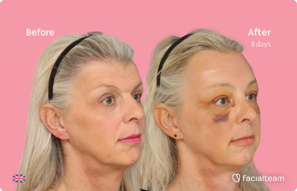 Right side 45 degree image of FFS patient Skye showing the results before and after facial feminization surgery consisting of forehead feminization surgery.
