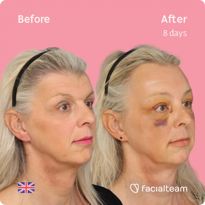 Right side square 45 degree image of FFS patient Skye showing the results before and after facial feminization surgery consisting of forehead feminization surgery.