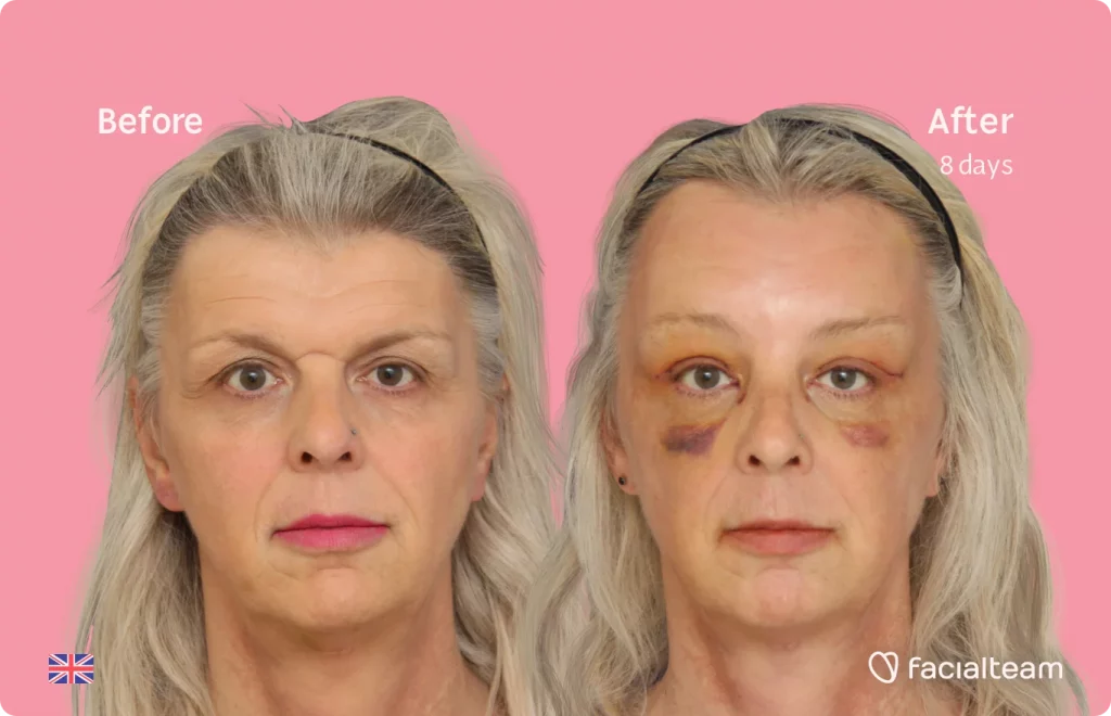 Frontal image of FFS patient Skye showing the results before and after facial feminization surgery with Facialteam consisting of forehead feminization surgery.