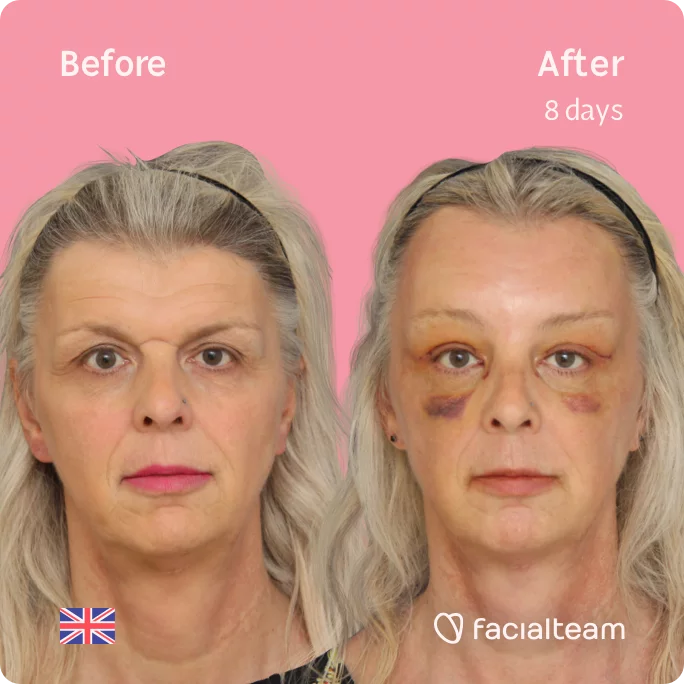Square frontal image of FFS patient Skye showing the results before and after facial feminization surgery with Facialteam consisting of forehead feminization surgery.