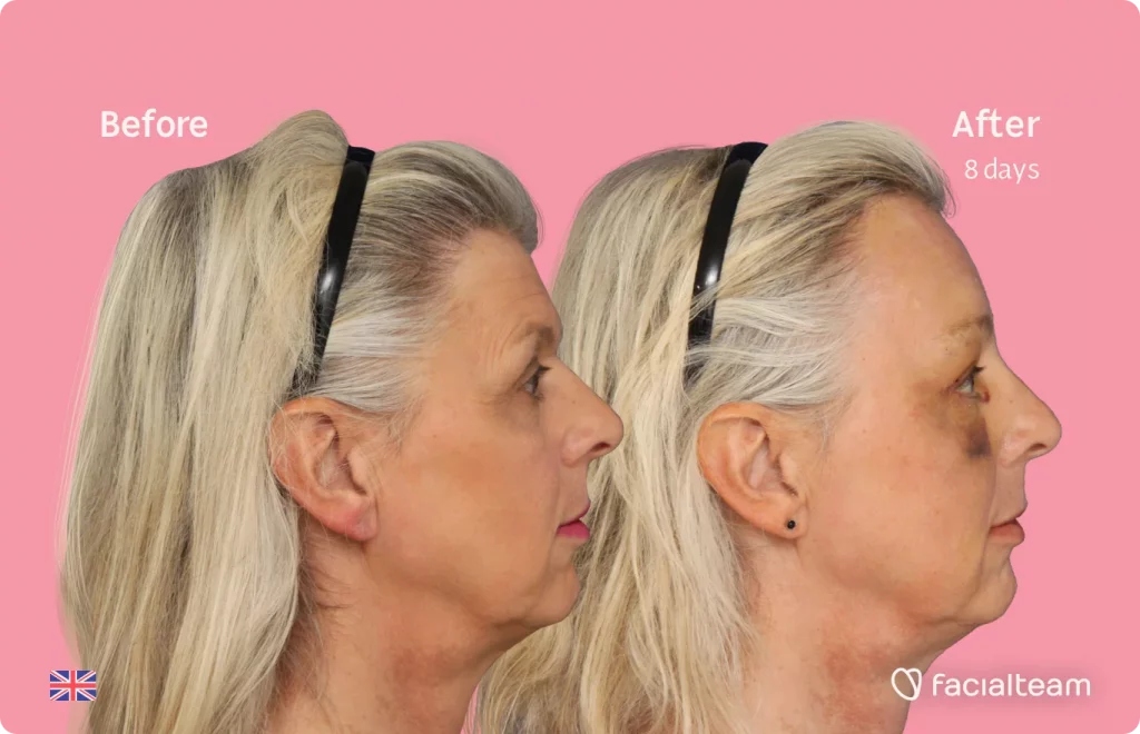 Side image of FFS patient Skye showing the results before and after facial feminization surgery with Facialteam consisting of forehead feminization surgery.