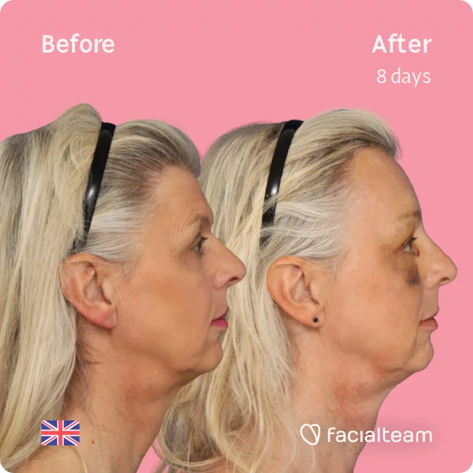 Square Side image of FFS patient Skye showing the results before and after facial feminization surgery with Facialteam consisting of forehead feminization surgery.