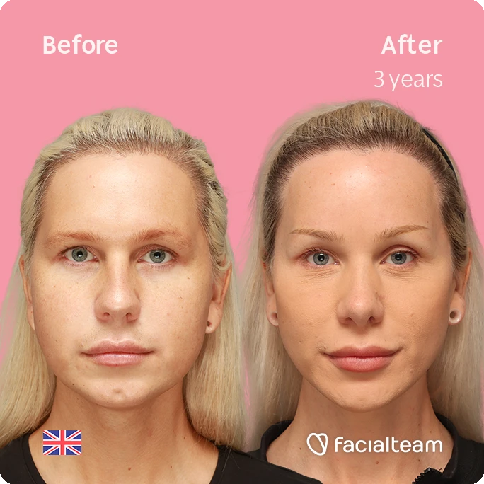 Side-by-side comparison of a woman's face before and after 3 years of treatment, showing smoother skin and fuller lips against a pink background.