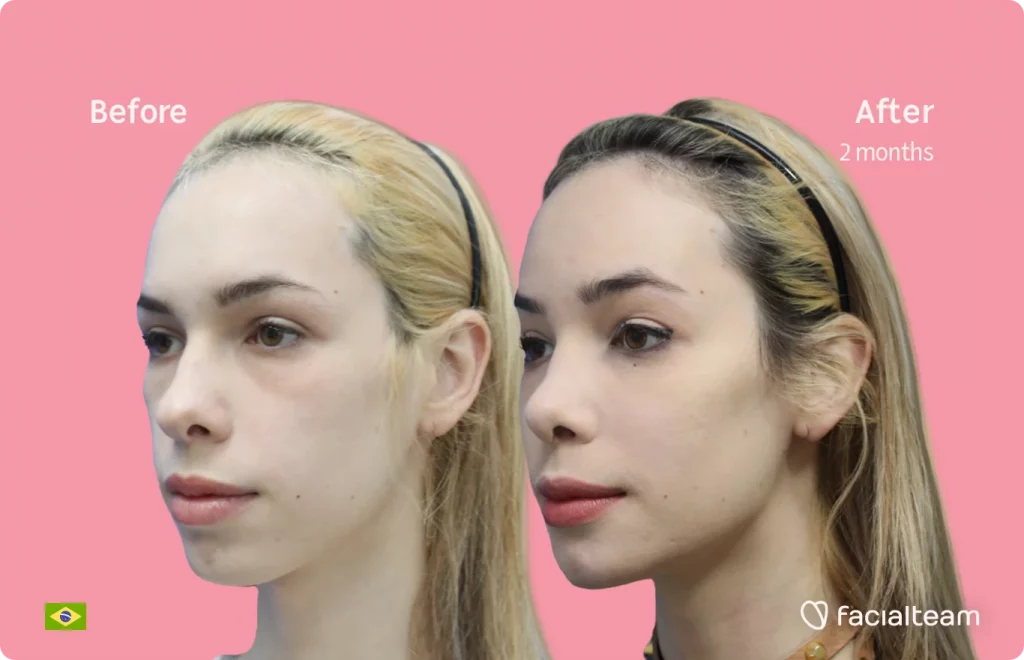 45 degree image of FFS patient Julia R showing the results before and after facial feminization surgery consisting of tracheal shave, forehead, jaw, chin, rhinoplasty feminization surgery.