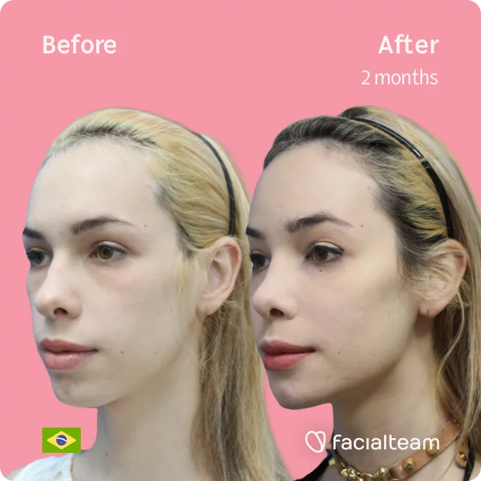 Square 45 degree image of FFS patient Julia R showing the results before and after facial feminization surgery consisting of tracheal shave, forehead, jaw, chin, rhinoplasty feminization surgery.