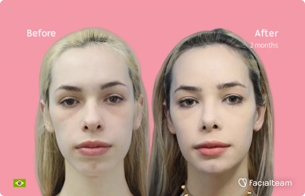 Frontal image of FFS patient Julia R showing the results before and after facial feminization surgery with Facialteam consisting of tracheal shave, forehead, jaw, chin, rhinoplasty feminization surgery.
