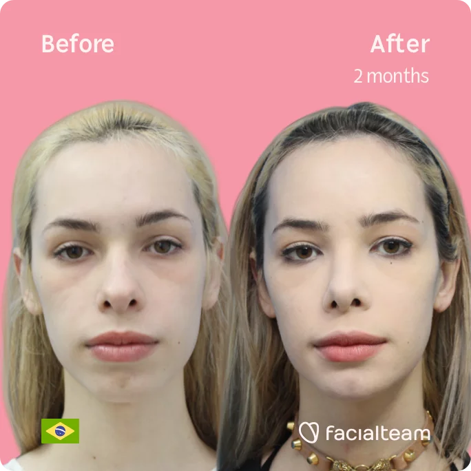 Square frontal image of FFS patient Julia R showing the results before and after facial feminization surgery with Facialteam consisting of tracheal shave, forehead, jaw, chin, rhinoplasty feminization surgery.