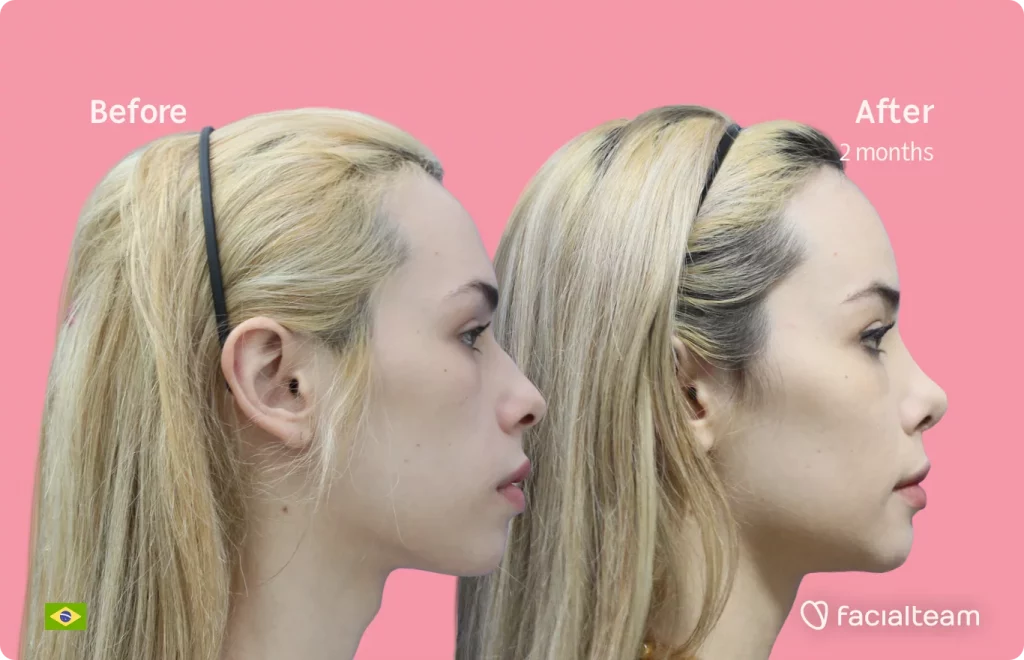 Side image of FFS patient Julia R showing the results before and after facial feminization surgery with Facialteam consisting of tracheal shave, forehead, jaw, chin, rhinoplasty feminization surgery.