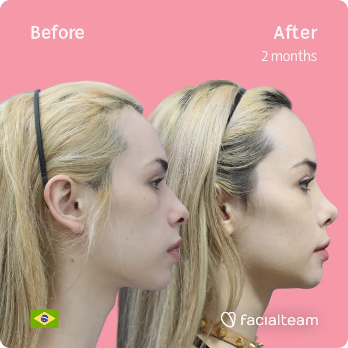 Square Side image of FFS patient Julia R showing the results before and after facial feminization surgery with Facialteam consisting of tracheal shave, forehead, jaw, chin, rhinoplasty feminization surgery.