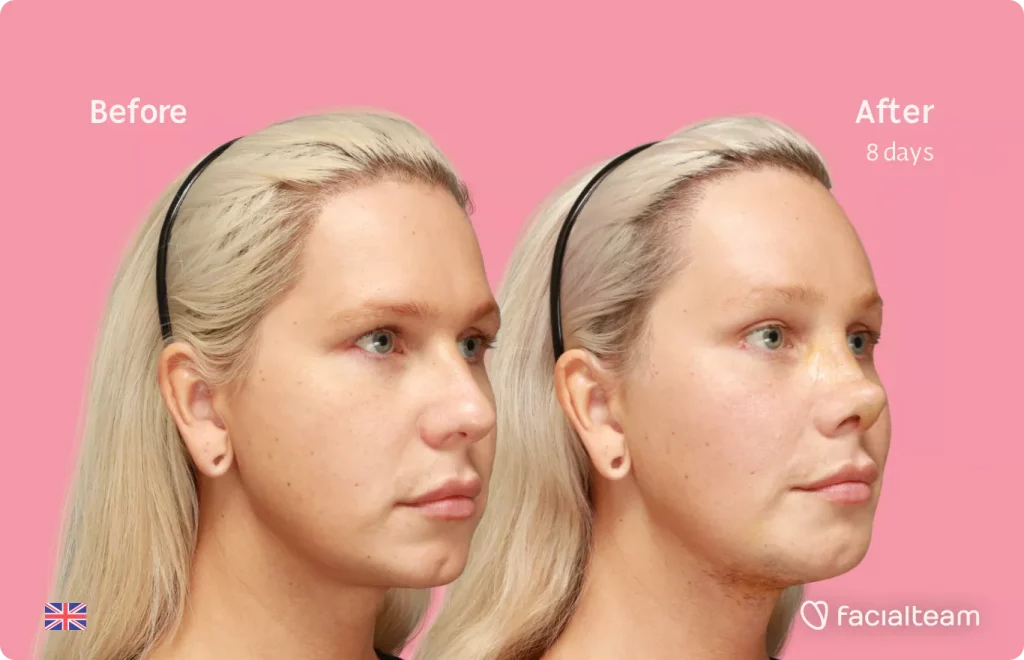 45 degree image of FFS patient Luxeria showing the results before and after facial feminization surgery consisting of Traquea Shave, forehead, rhinoplasty, chin feminization surgery.