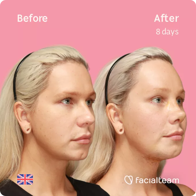 Square 45 degree image of FFS patient Luxeria showing the results before and after facial feminization surgery consisting of Traquea Shave, forehead, rhinoplasty, chin feminization surgery.