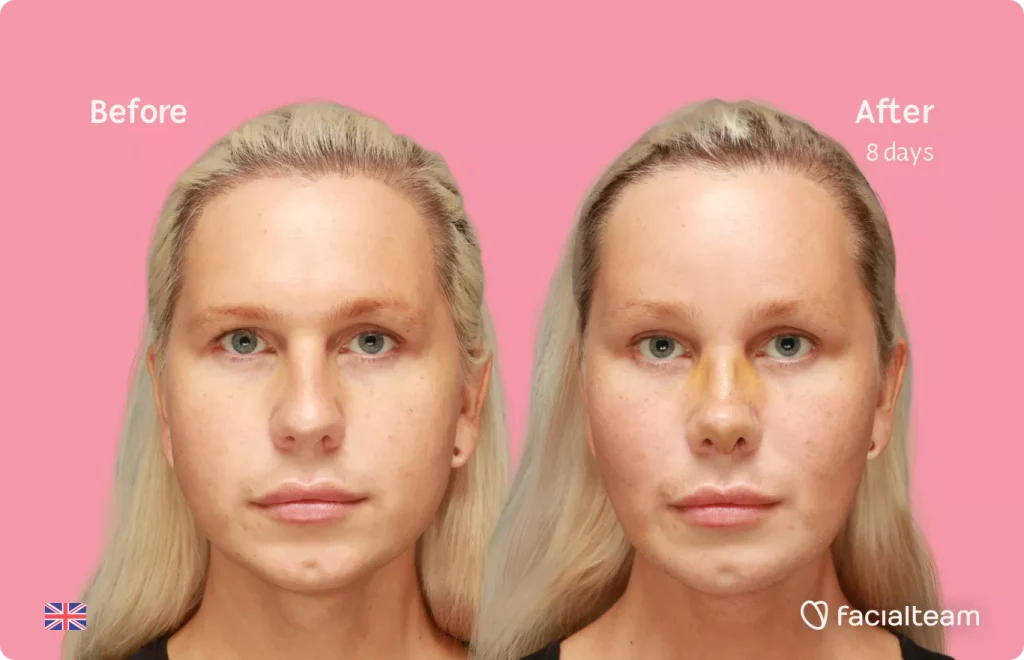 Frontal image of FFS patient Luxeria showing the results before and after facial feminization surgery with Facialteam consisting of Traquea Shave, forehead, rhinoplasty, chin feminization surgery.
