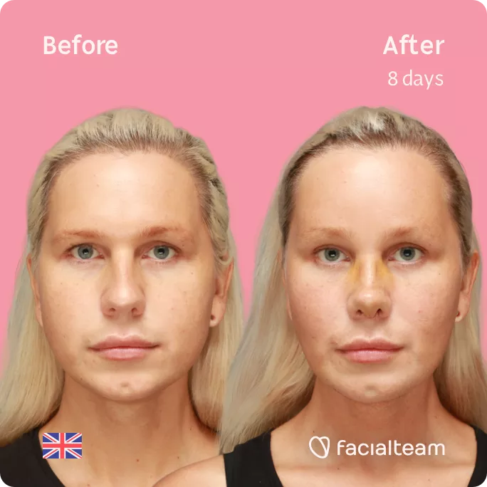 Square frontal image of FFS patient Luxeria showing the results before and after facial feminization surgery with Facialteam consisting of Traquea Shave, forehead, rhinoplasty, chin feminization surgery.