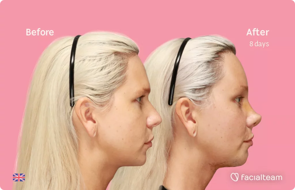 Side image of FFS patient Luxeria showing the results before and after facial feminization surgery with Facialteam consisting of Traquea Shave, forehead, rhinoplasty, chin feminization surgery.