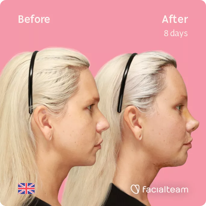 Square Side image of FFS patient Luxeria showing the results before and after facial feminization surgery with Facialteam consisting of Traquea Shave, forehead, rhinoplasty, chin feminization surgery.