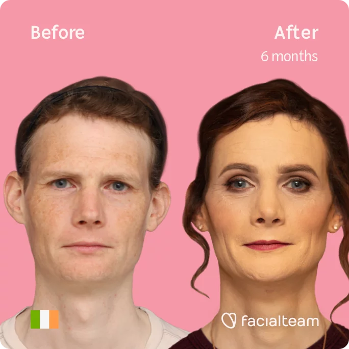Square frontal image of FFS patient Jennifer showing the results before and after facial feminization surgery with Facialteam consisting of tracheal shave, forehead with SHT, jaw, chin, rhinoplasty feminization surgery.