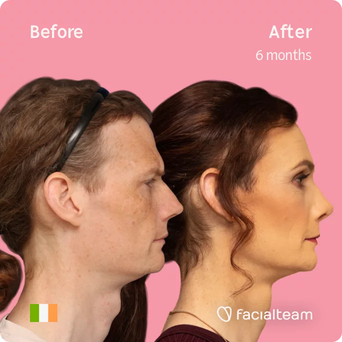 Square Side image of FFS patient Jennifer showing the results before and after facial feminization surgery with Facialteam consisting of tracheal shave, forehead with SHT, jaw, chin, rhinoplasty feminization surgery.