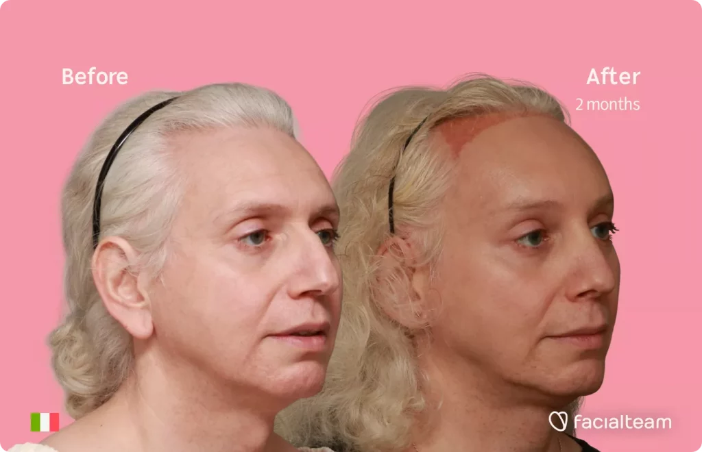 45 degree image of FFS patient Elisa showing the results before and after facial feminization surgery consisting of tracheal shave, forehead with SHT, rhinoplasty feminization surgery.