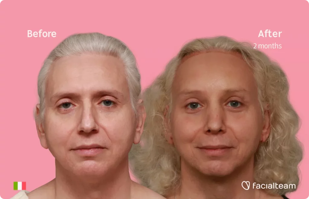 Frontal image of FFS patient Elisa showing the results before and after facial feminization surgery with Facialteam consisting of tracheal shave, forehead with SHT, rhinoplasty feminization surgery.