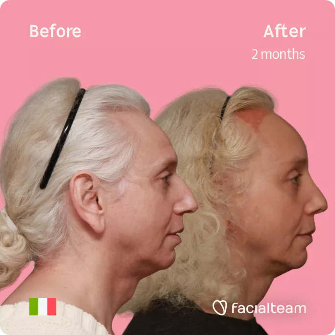 Square Side image of FFS patient Elisa showing the results before and after facial feminization surgery with Facialteam consisting of tracheal shave, forehead with SHT, rhinoplasty feminization surgery.