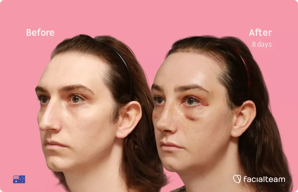 Left side 45 degree image of FFS patient Maddison showing the results before and after facial feminization surgery consisting of tracheal shave, forehead with SHT, rhinoplasty, jaw, chin feminization surgery.