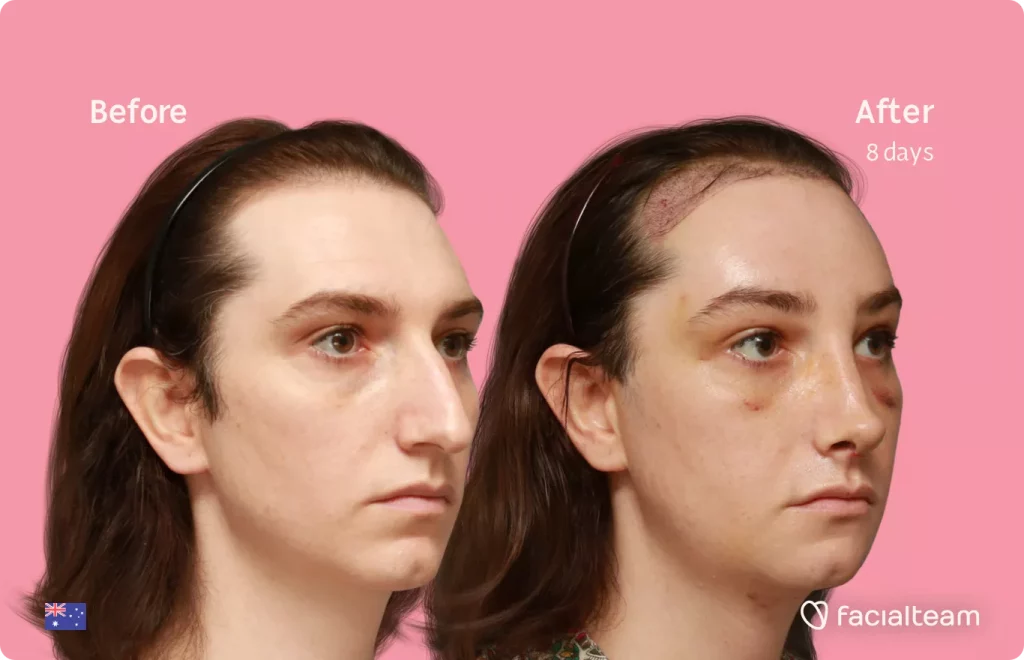45 degree image of FFS patient Maddison showing the results before and after facial feminization surgery consisting of tracheal shave, forehead with SHT, rhinoplasty, jaw, chin feminization surgery.