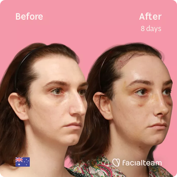Square 45 degree image of FFS patient Maddison showing the results before and after facial feminization surgery consisting of tracheal shave, forehead with SHT, rhinoplasty, jaw, chin feminization surgery.
