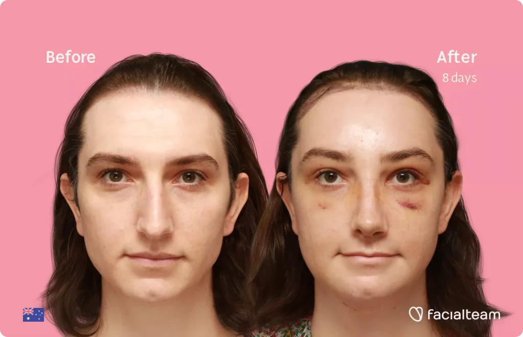 Frontal image of FFS patient Maddison showing the results before and after facial feminization surgery with Facialteam consisting of tracheal shave, forehead with SHT, rhinoplasty, jaw, chin feminization surgery.