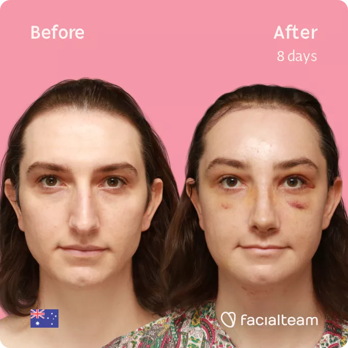 Square frontal image of FFS patient Maddison showing the results before and after facial feminization surgery with Facialteam consisting of tracheal shave, forehead with SHT, rhinoplasty, jaw, chin feminization surgery.