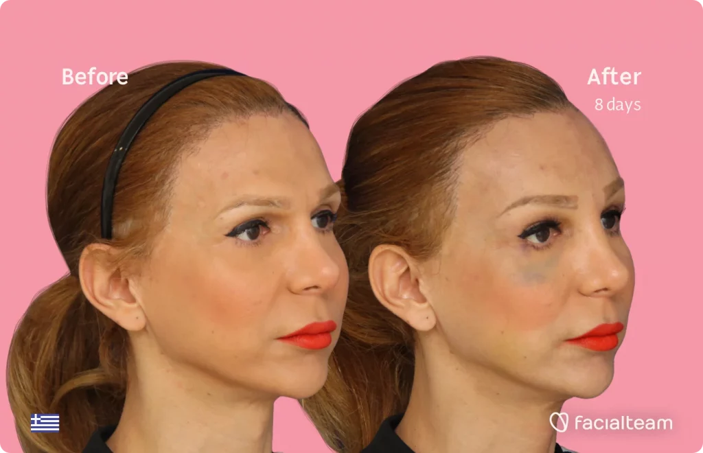 45 degree image of FFS patient Nadia showing the results before and after facial feminization surgery consisting of tracheal shave, forehead feminization surgery.
