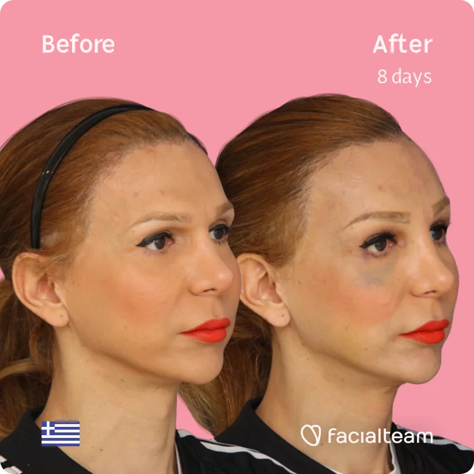 Square 45 degree image of FFS patient Nadia showing the results before and after facial feminization surgery consisting of tracheal shave, forehead feminization surgery.