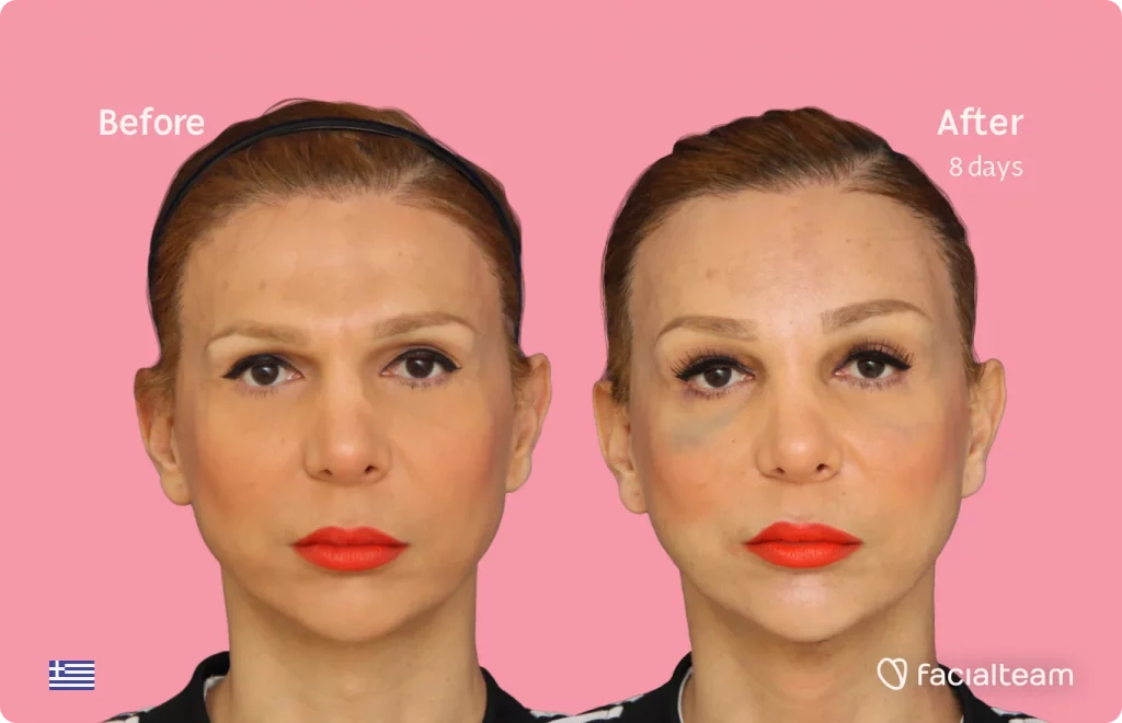 Frontal image of FFS patient Nadia showing the results before and after facial feminization surgery with Facialteam consisting of tracheal shave, forehead feminization surgery.