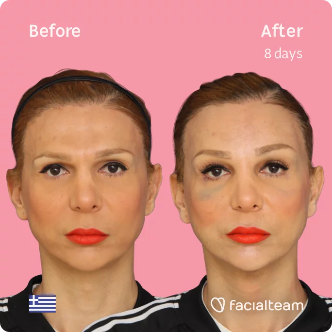 Square frontal image of FFS patient Nadia showing the results before and after facial feminization surgery with Facialteam consisting of tracheal shave, forehead feminization surgery.