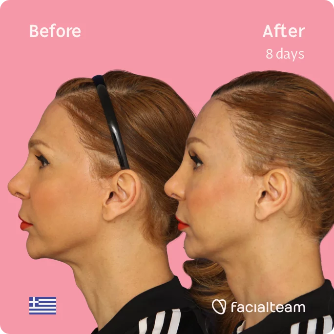 Left square side image of FFS patient Nadia showing the results before and after facial feminization surgery with Facialteam consisting of tracheal shave, forehead feminization surgery.