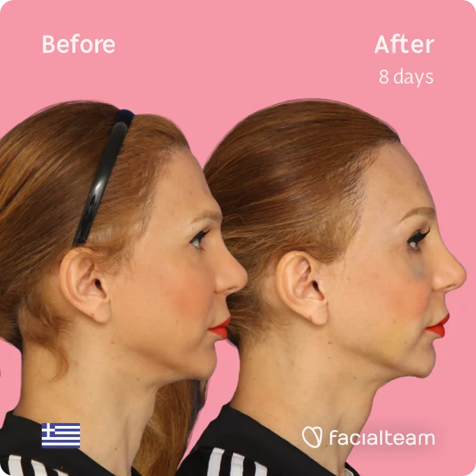 Square Side image of FFS patient Nadia showing the results before and after facial feminization surgery with Facialteam consisting of tracheal shave, forehead feminization surgery.