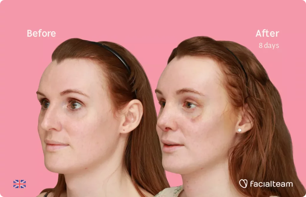 Left side 45 degree image of FFS patient Charlotte R showing the results before and after facial feminization surgery consisting of tracheal shave, forehead, rhinoplasty feminization surgery.