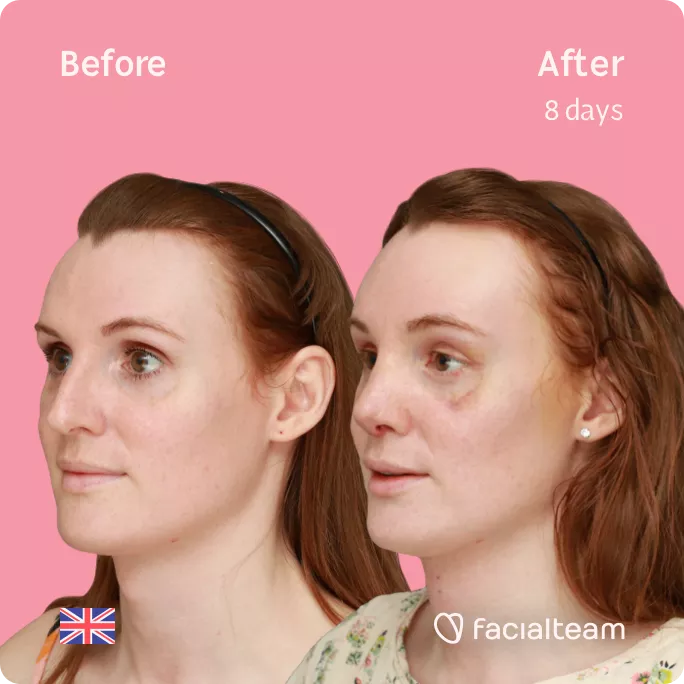 Square 45 degree image of FFS patient Charlotte R showing the results before and after facial feminization surgery consisting of tracheal shave, forehead, rhinoplasty feminization surgery.