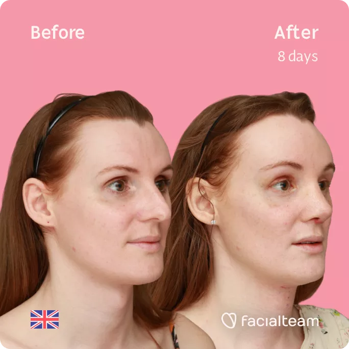 Right side square 45 degree image of FFS patient Charlotte R showing the results before and after facial feminization surgery consisting of tracheal shave, forehead, rhinoplasty feminization surgery.