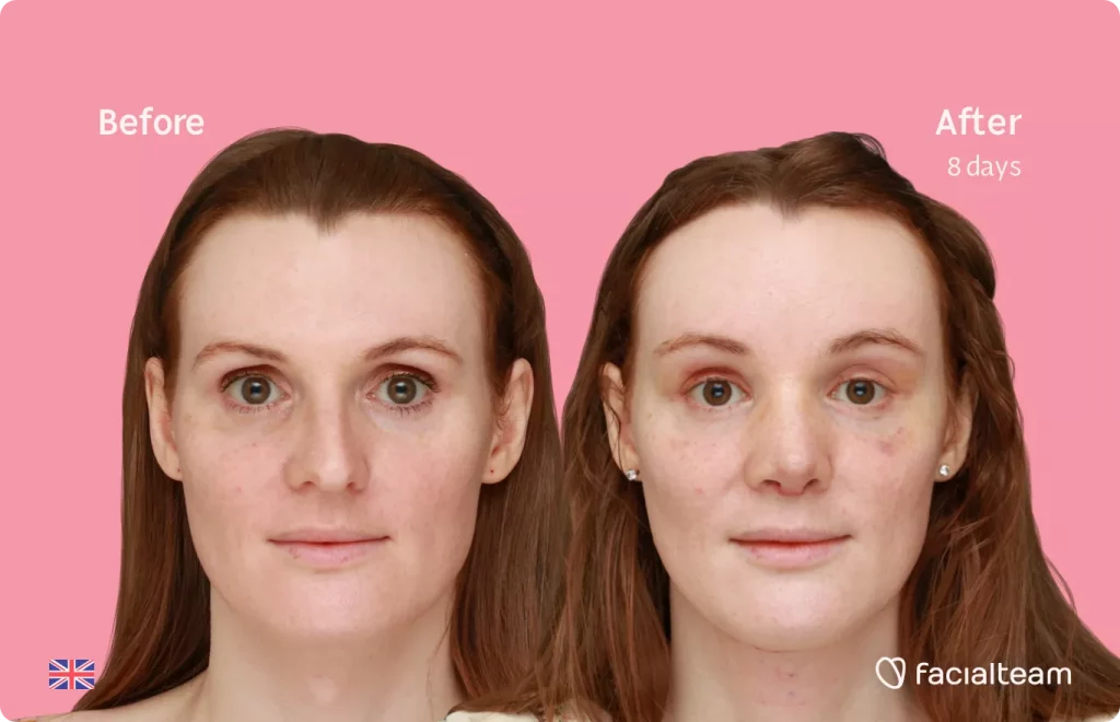 Frontal image of FFS patient Charlotte R showing the results before and after facial feminization surgery with Facialteam consisting of tracheal shave, forehead, rhinoplasty feminization surgery.