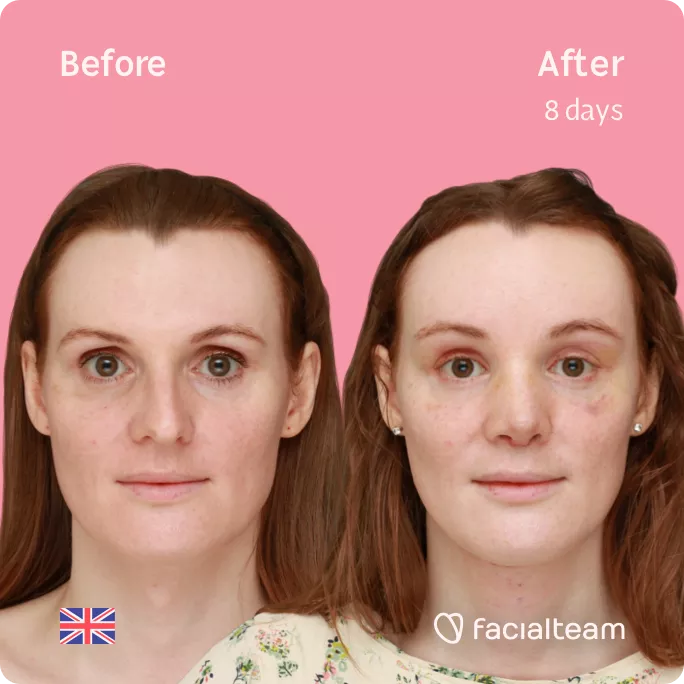 Square frontal image of FFS patient Charlotte R showing the results before and after facial feminization surgery with Facialteam consisting of tracheal shave, forehead, rhinoplasty feminization surgery.